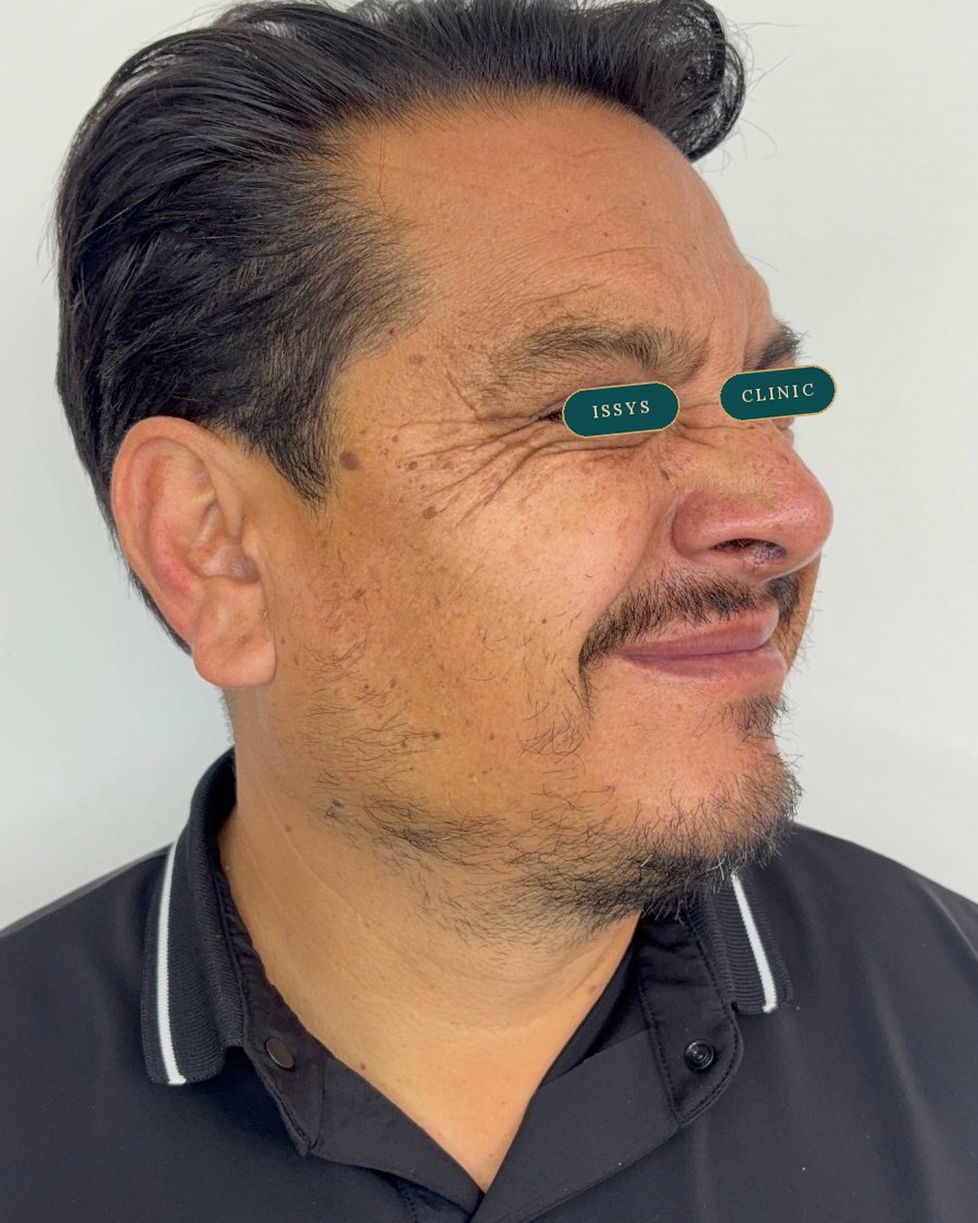 Antes del tratamiento: perfil