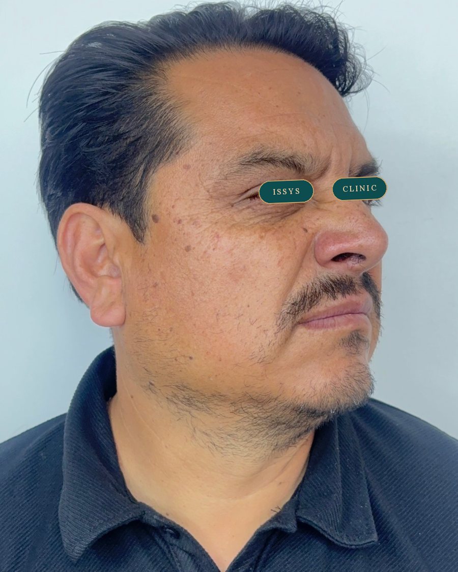 Después del tratamiento: perfil